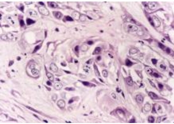 冉明医师创新国医精粹 铺就患者“健康之路”中医传承百年古方抗癌”消癌法”