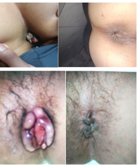 痛风结石老鼠疮乳腺增生无效退款广西百色杨忠雅医师