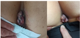 痛风结石老鼠疮乳腺增生无效退款广西百色杨忠雅医师