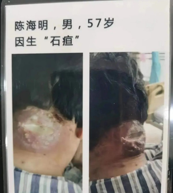 妙手仁心传古方，悬壶济世暖人间——记民间中医苏专荣